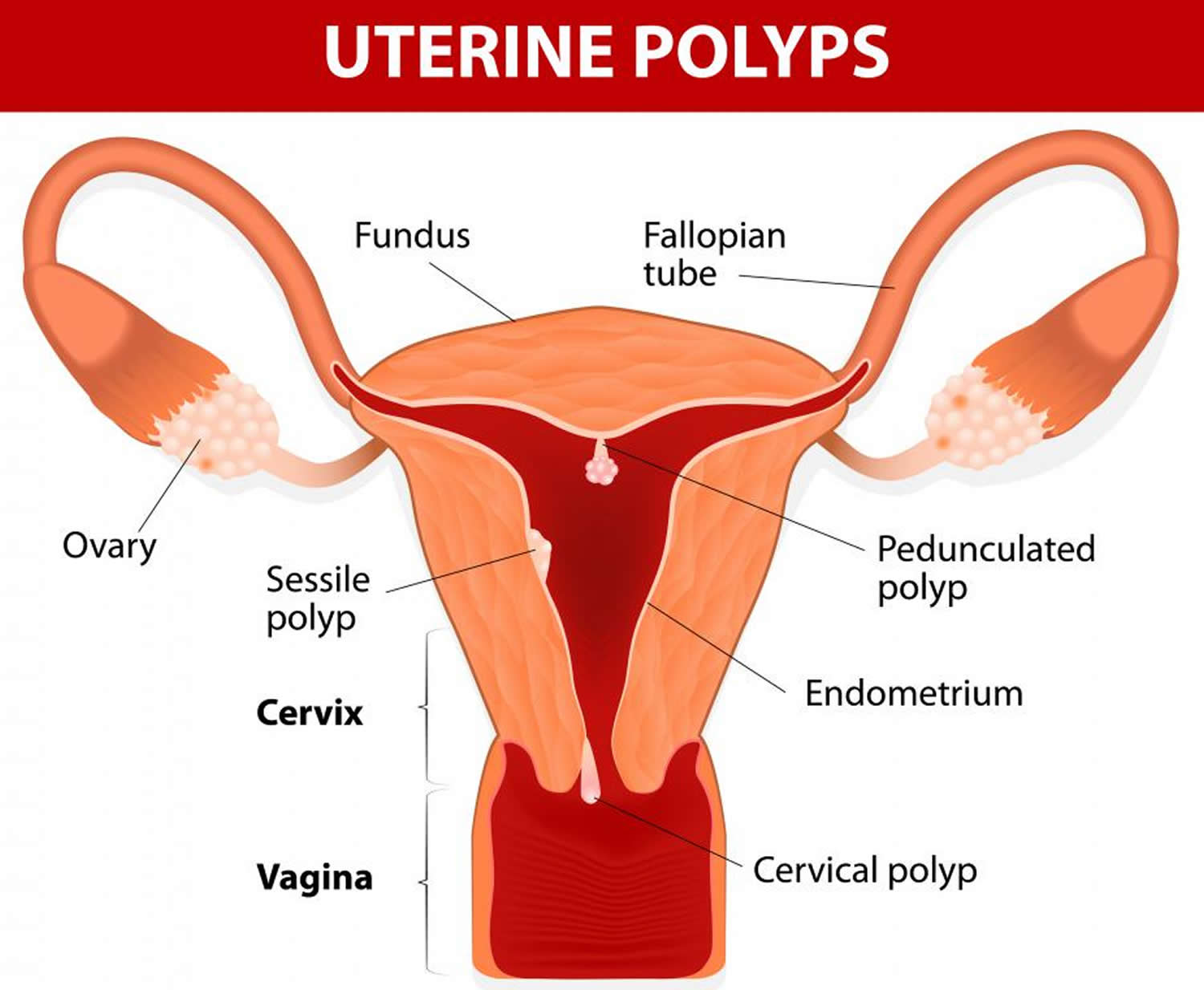 uterine polyps