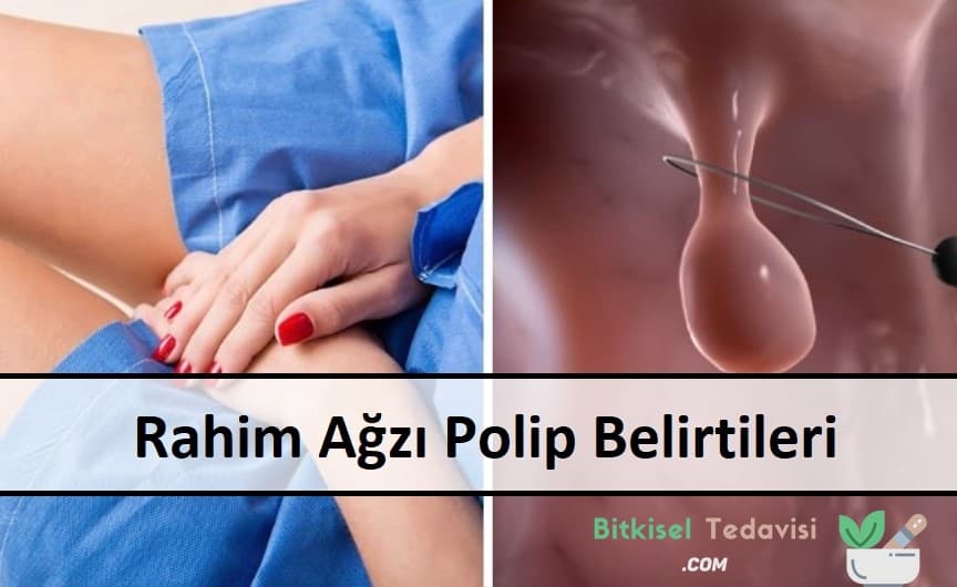 rahim agzi polip belirtileri